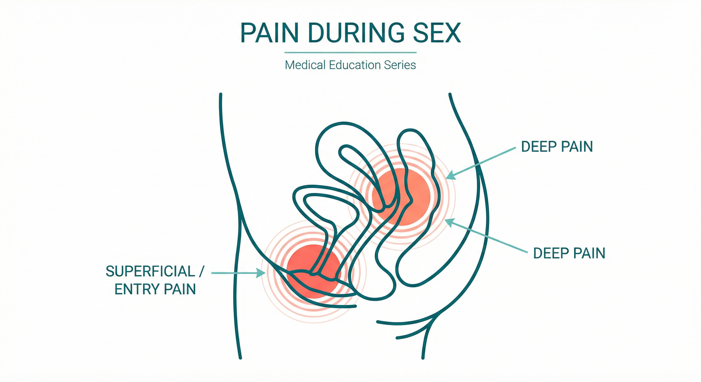Types of Pain During Sex - Entry vs Deep Pain