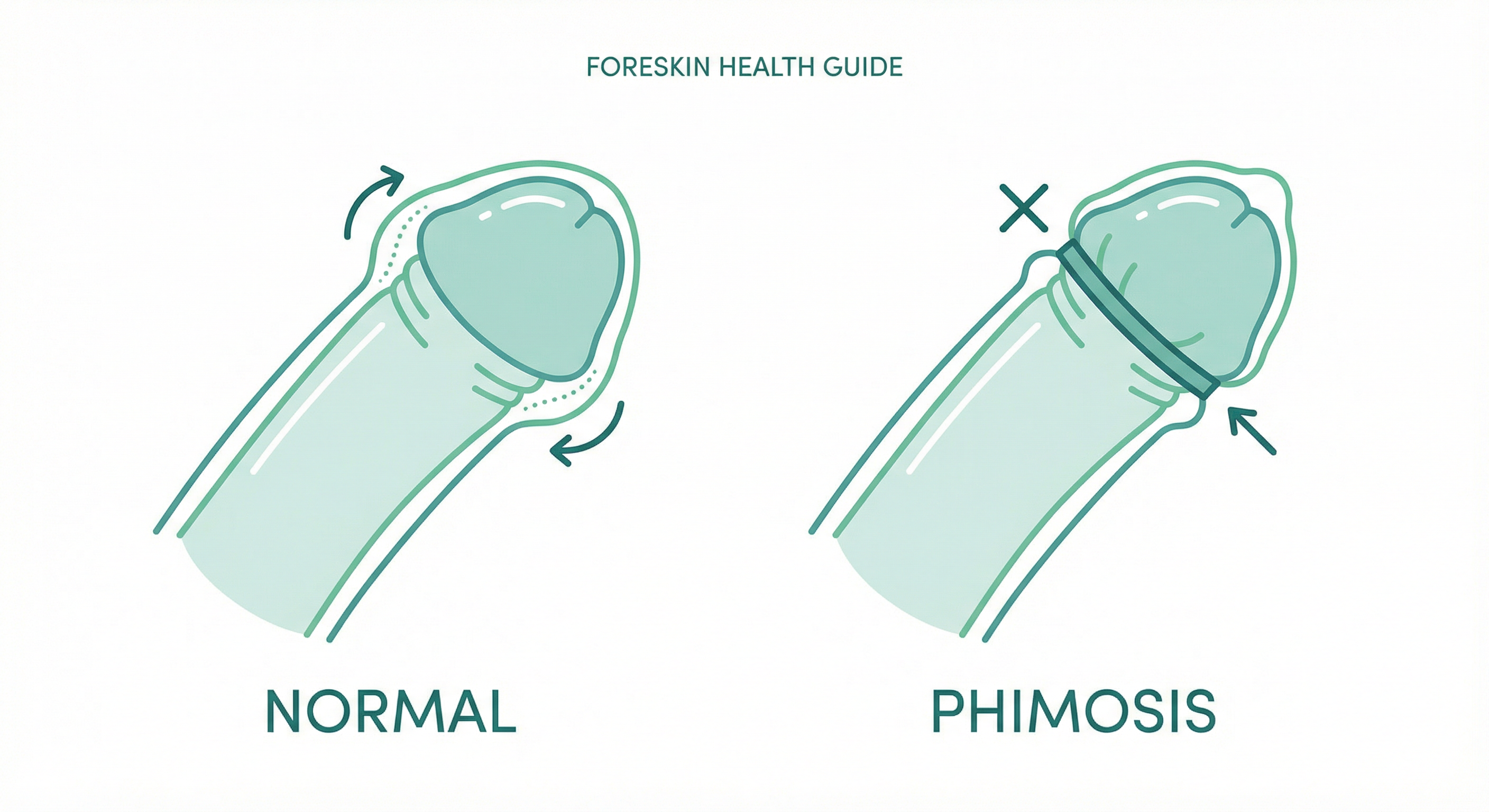 Phimosis comparison - normal vs tight foreskin